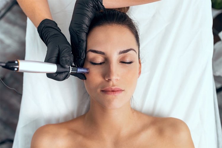 Interested in microneedling? Here's everything you should know before booking an appointment