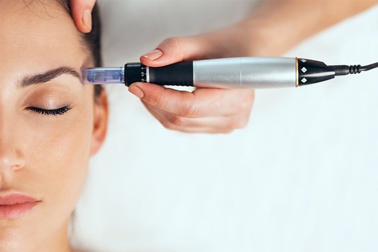 Interested in microneedling? Here's everything you should know before booking an appointment