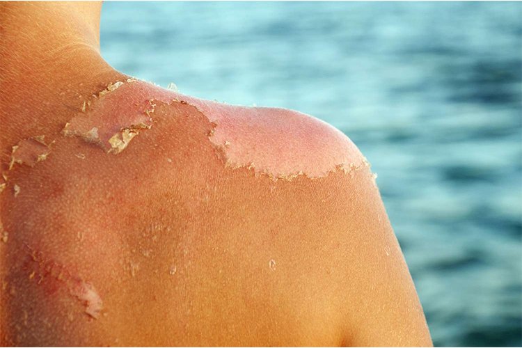 How to get rid of flaking skin after sunburn?