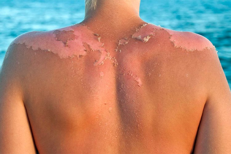 How to get rid of flaking skin after sunburn?