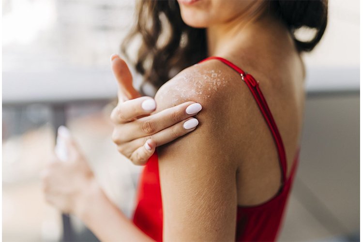 How to get rid of flaking skin after sunburn?